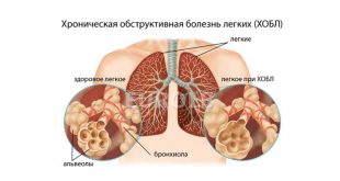 ХОБЛ или хроническая обструктивная болезнь