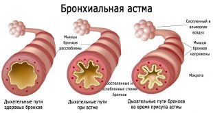 Эта реакция в весенний период связана с началом цветения деревьев и растений и попаданием их пыльцы на слизистую дыхательных путей.